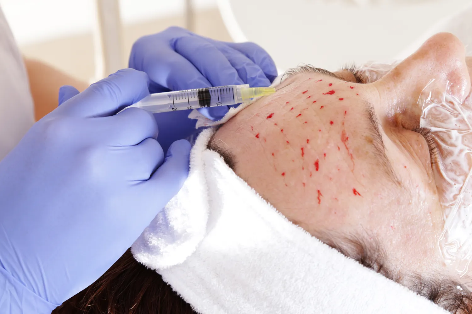 Co na worki pod oczami medycyna estetyczna?