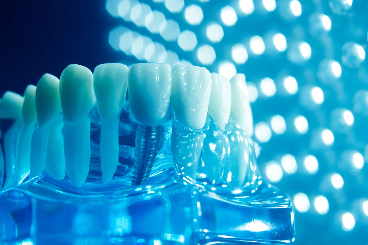 Implanty jarzmowe co to?