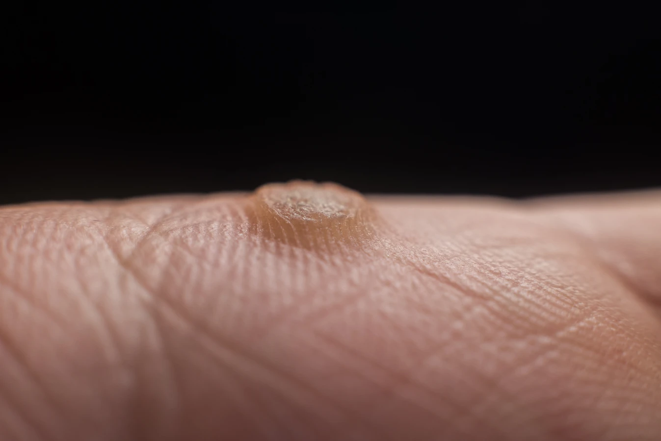 Jaskółcze ziele jak stosować na kurzajki?