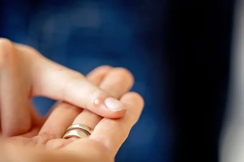 Skąd biorą się kurzajki?